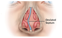 SleepFacts_EckCreativeMedia_Deviated_Sptum
