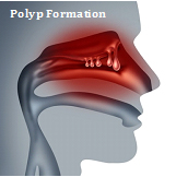 SleepFacts_EckCreativeMedia_Polyp_Formation