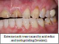 SleepFacts_EckCreativeMedia_Design_Extreme_Tooth_Wear